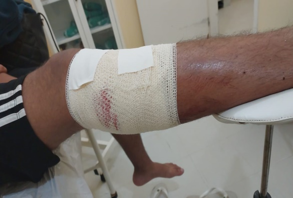 Adolescente é atacado por cachorro em Livramento