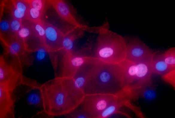 Número de casos de câncer entre jovens cresce 79% em 30 anos