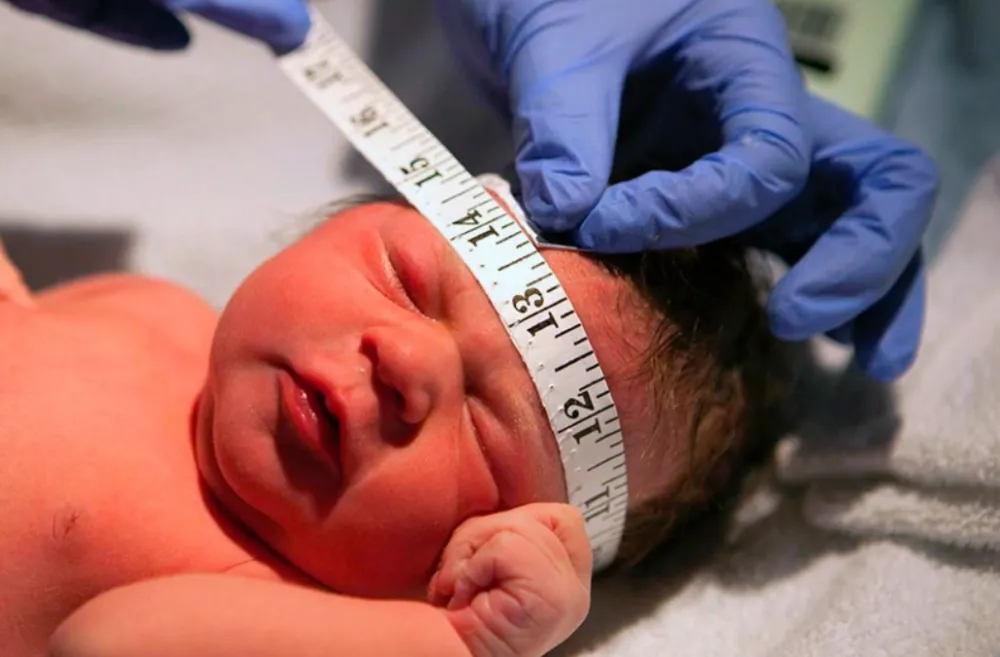 Governo regulamenta indenização e pensão para crianças com sequelas do zika vírus