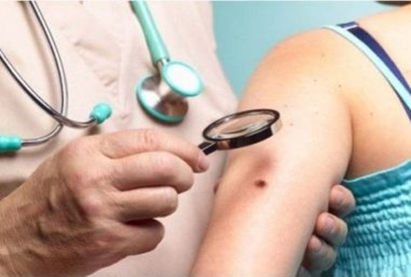 Estudo revela proteína que tem papel central no desenvolvimento do melanoma