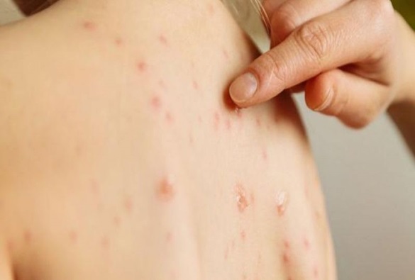 Bahia registrou 752 casos suspeitos de sarampo em 16 municípios em 2019