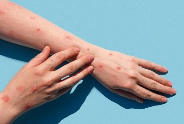 Ministério da Saúde confirma primeira morte por varíola dos macacos no Brasil