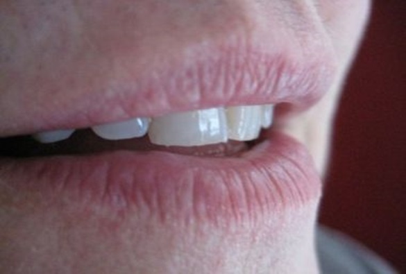 Criado por acidente, gel promete acabar com feridas de herpes em apenas um dia