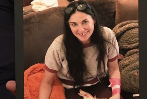 Demi Moore conta que perdeu dois dentes da frente por causa de estresse