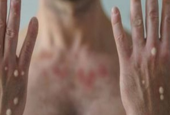 Ministério da Saúde classifica varíola dos macacos com nível máximo de emergência nacional
