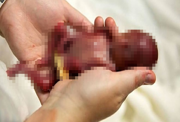 Projeto de lei pretende mostrar imagens de fetos a vítimas de estupro que planejam aborto