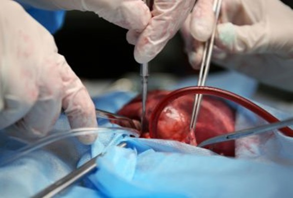 Com aumento de 75%, Brasil registra recorde de doadores de órgãos