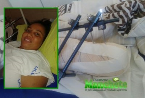 Livramento: Mulher tem perna amputada após sofrer fratura grave