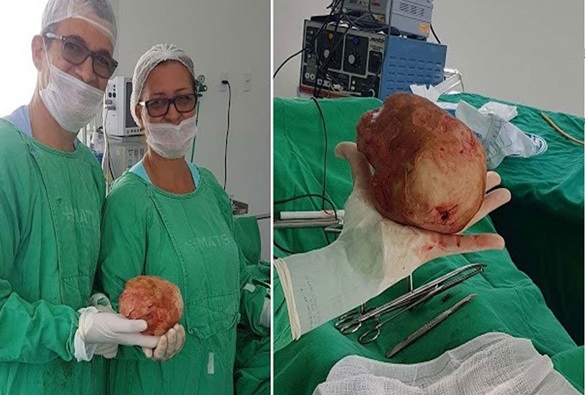 Paciente baiano retira pedra de mais de um quilo da bexiga 