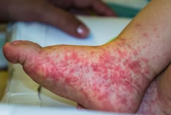 'Gripe do tomate': o que é o novo vírus identificado na Índia