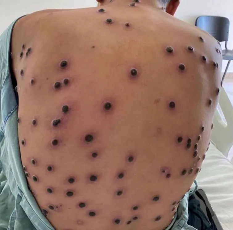 Norte do Brasil registra casos de varíola dos macacos